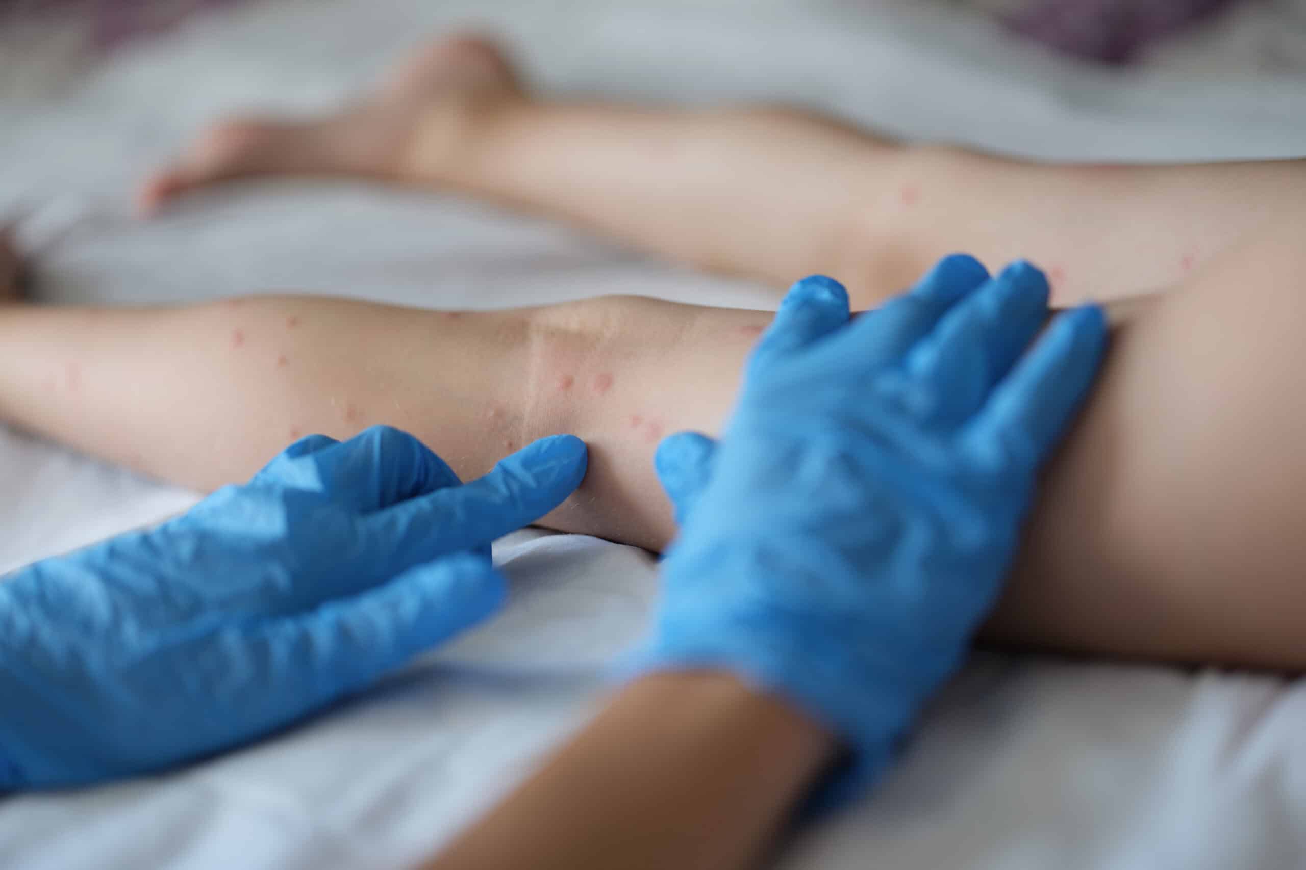Close-up of family doctor examining red rash on legs of child in clinic. Kids naked legs on appointment, irritation on body. Medicine, healthcare concept